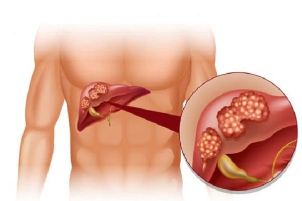 Ung thư biểu mô gan là loại ung thư gan phổ biến hơn cả