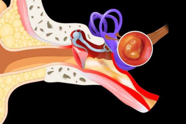Viêm tai giữa dễ tái phát do không điều trị dứt điểm hoặc sinh hoạt không đảm bảo