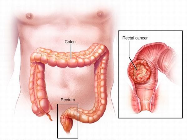 Trong số các bệnh lý ở trực tràng thì bệnh ung thư hậu môn trực tràng là nguy hiểm nhất.