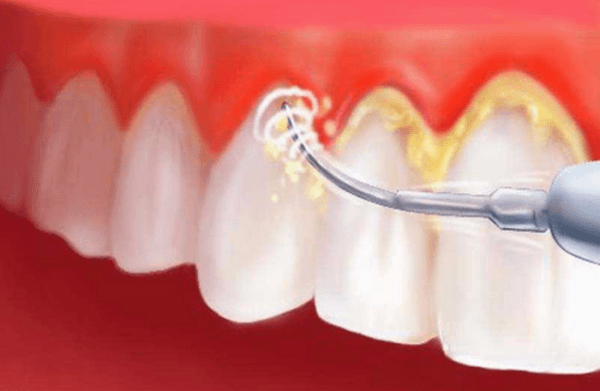 Bệnh viêm nha chu