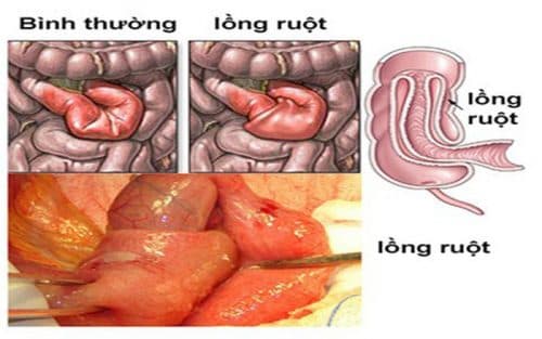 Lồng ruột là nguyên nhân gây bệnh tắc ruột phổ biến nhất ở trẻ em