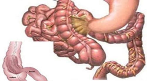 Nhận biết sớm các biểu hiện của xoắn ruột giúp chúng ta chủ động trong việc phát hiện bệnh, khám chữa kịp thời, tránh những biến chứng nguy hiểm của bệnh.