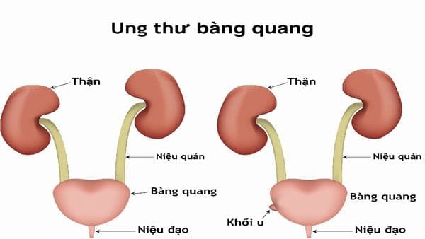 Ung thư bàng quang là một khối u bắt đầu trong bàng quang