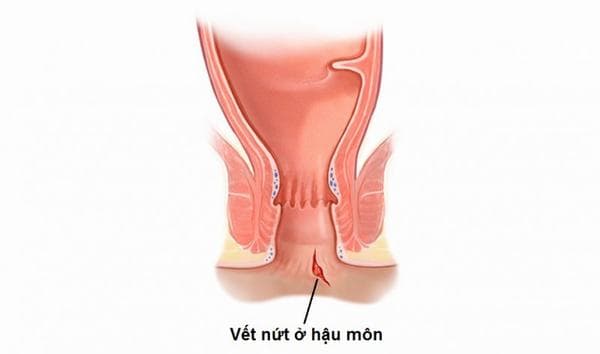 Bệnh nứt kẽ hậu môn gây nhiều phiến toái cho người bệnh, khiến người bệnh khó chịu ảnh hưởng tới sức khỏe