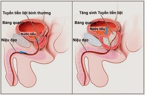 Viêm bàng quang có thể là tác nhân gây tiểu nhiều lần