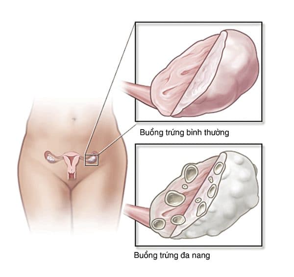 Đa nang buồng trứng khá phổ biến ở nữ giới, có thể gây vô sinh