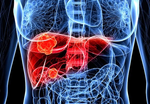Dấu hiệu ung thư gan tái phát như thế nào