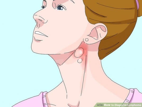 Các phương pháp điều trị ung thư hạch