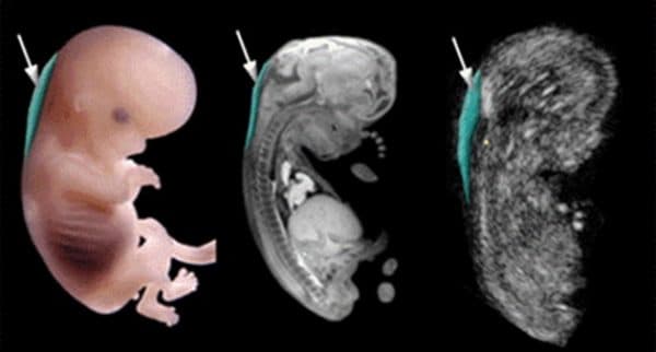 Độ mờ da gáy bao nhiêu là tốt là thắc mắc của nhiều người.
