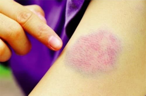 Não và đường tiêu hóa là 2 cơ quan dễ bị xuất huyết nhất khi bị giảm tiểu cầu.