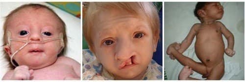 Trẻ sinh ra với những bất thường nghiêm trọng ở ngoại hình, thiểu năng trí tuệ...