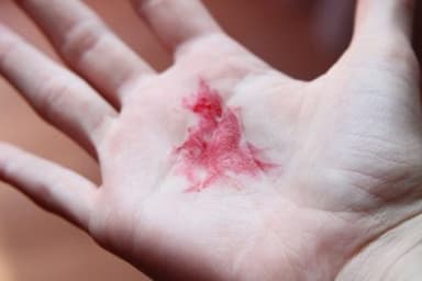 Khạc đờm có máu – cẩn thận kẻo ung thư vòm họng