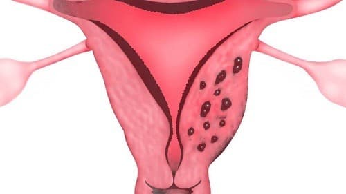 Lạc nội mạc tử cung là tình trạng không hiếm gặp ở các chị em. 