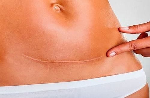 Mang thai sau sinh mổ 10 tháng làm tăng nguy cơ nứt vỡ tử cung.