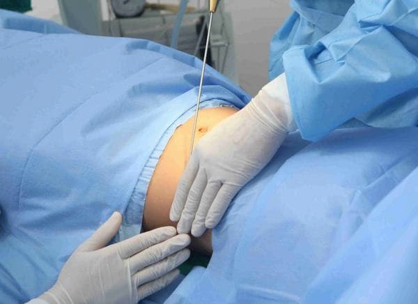 Béo phì làm tăng nguy cơ mắc bệnh sỏi thận 