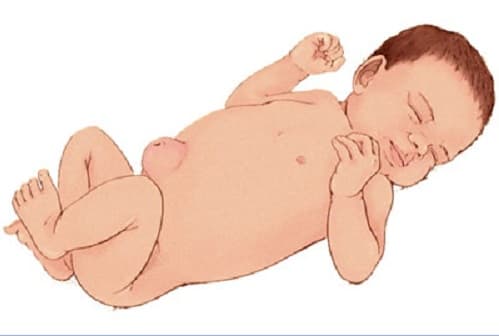 Thoát vị rốn là tình trạng xảy ra khi một phần của ruột nhô ra qua một lỗ trên các cơ bụng.