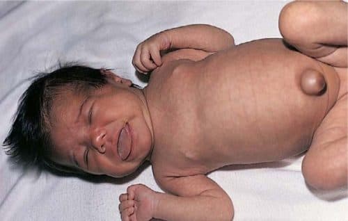 Để biết thêm thông tin chi tiết hoặc cần giải đáp thêm về nguyên nhân thoát vị rốn, bạn đọc vui lòng liên hệ với Bệnh viện Đa khoa Quốc tế Thu Cúc  theo số điện thoại 024.383.55555 hoặc 1900 558892 hoặc hotline: 0936 388 288.