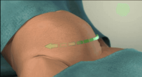 Racahj mổ tử cung tại bệnh viện để đưa em bé ra khỏi túi ối