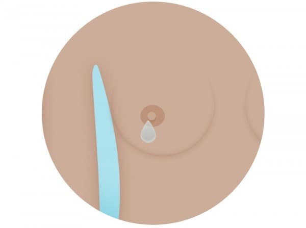 Núm vú tiết dịch có dính máu là một trong những triệu chứng cảnh báo ung thư vú nữ giới không nên bỏ qua