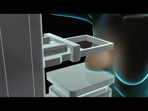 Chụp quang tuyến vú