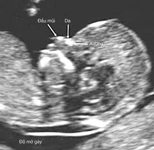 Siêu âm độ mờ da gáy là một xét nghiệm quan trọng phát hiện nguy cơ hội chứng Down ngay giai đoạn đầu tiên thai kỳ. 