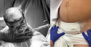 vết rạch tại bụng để lấy em bé ra