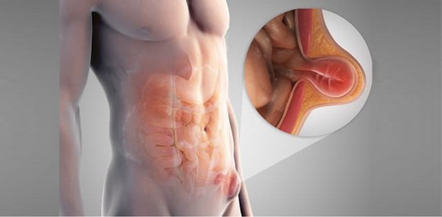 Tắc ruột là gì? Hệ Thống Y Tế Thu Cúc