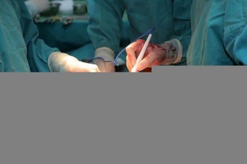 Phẫu thuật là biện pháp điều trị tốt nhất, cứu nguy tính mạng người bệnh bị sa ruột