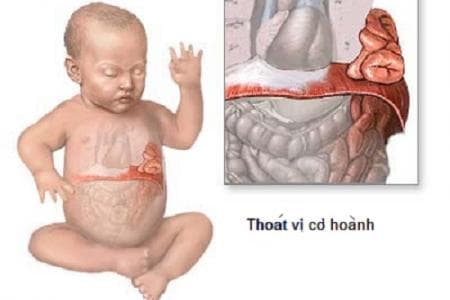 Thoát vị hoành là sự nhô lên của phần trên của dạ dày thông qua cơ hoành – cơ dạng hình vòm phân chia hai khoang ngực và bụng. 