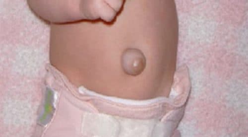 Nhận biết sớm các triệu chứng thoát vị rốn ở trẻ giúp cha mẹ chủ động trong việc thăm khám và điều trị (nếu cần). 