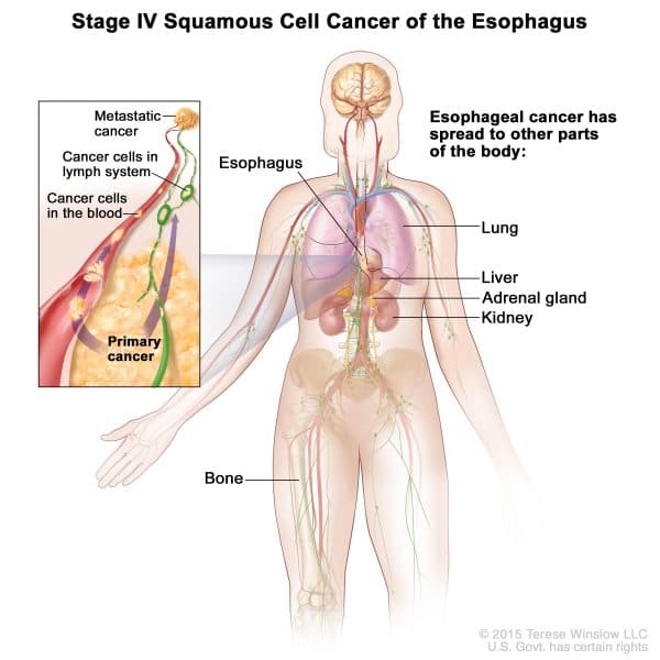 Ung thực quản giai đoạn cuối có khả năng di căn đến nhiều cơ quan ở xa, trong đó có gan