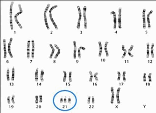Nhưng khi bị trisomy 21, thì nhiễm sắc thể 21 lại thừa ra 1 NST, bao gồm 3 nhiễm sắc thể ở tất cả các tế bào trong cơ thể. 