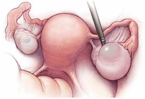 U nang buồng trứng trái có nguy hiểm không?