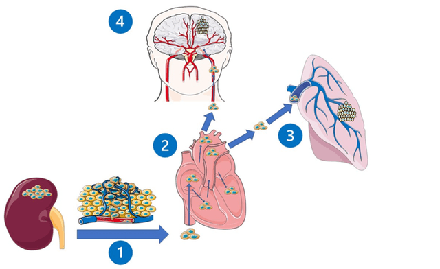 Ung thư thận di căn: Biểu hiện và tiên lượng sống