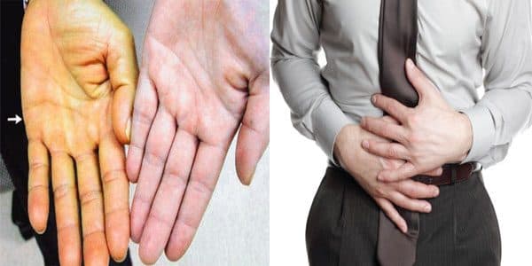 Ung thư vòm họng di căn đến gan gây ra một loạt các biểu hiện như ung vàng da, đau tức bụng trên...