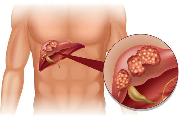 Ung thư vòm họng giai đoạn cuối có khả năng di căn đến nhiều cơ quan ở xa, trong đó có gan