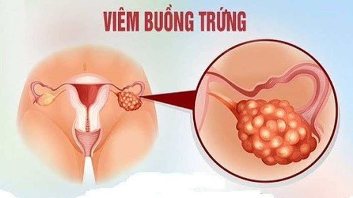 Những nguyên nhân gây ra viêm buồng trứng