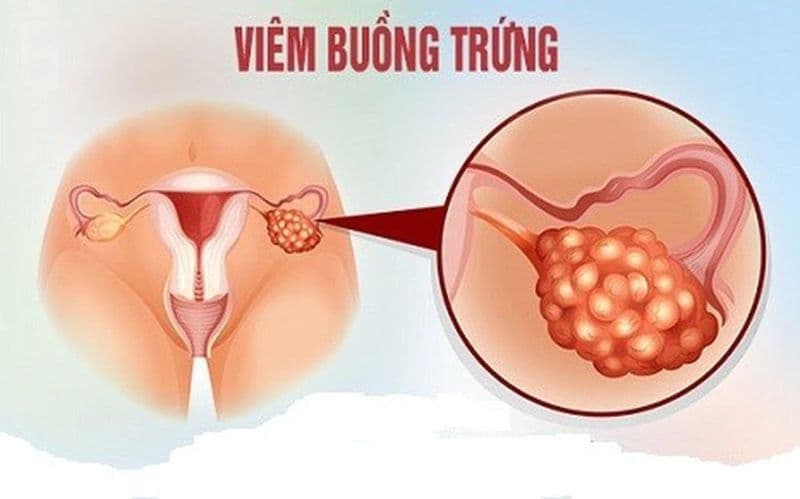 Viêm buồng trứng còn có thể là do quan hệ tình dục không an toàn, quan hệ quá sớm…