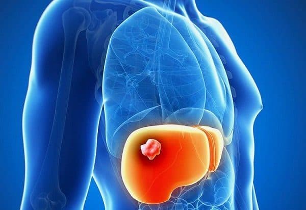 Những người mắc viêm gan B ,mạn tiến triển xơ gan có nguy cơ mắc ung thư gan cao hơn so với những người khác