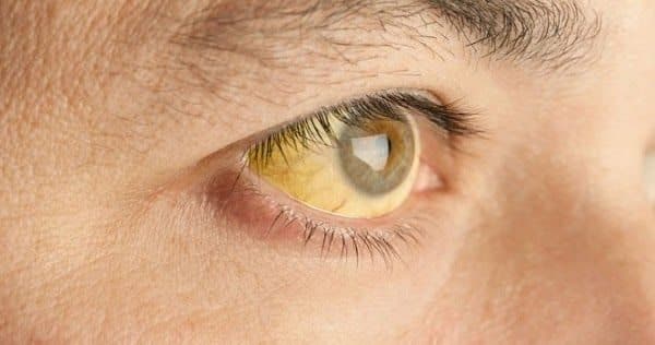 Vàng da, vàng mắt là một trong những biểu hiện thường gặp ở người mắc viêm gan B