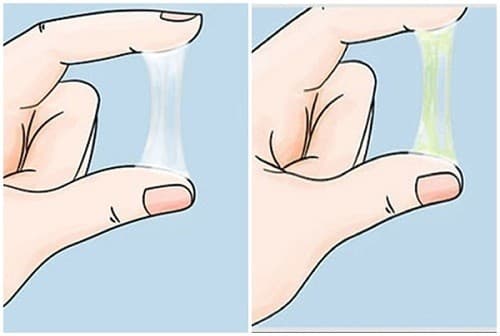 Khí hư ra nhiều bất thường là triệu chứng viêm lộ tuyến cổ tử cung