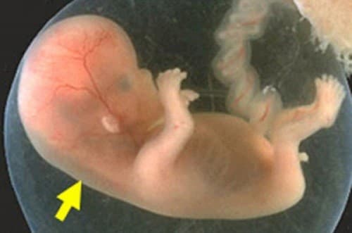 Xét nghiệm độ mờ da gáy có ý nghĩa gì?