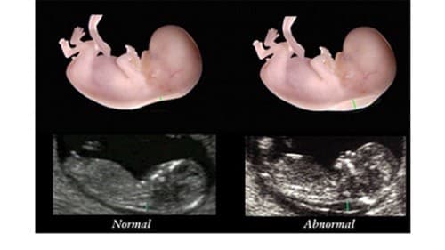 Kết quả xét nghiệm độ mờ da gáy giúp cân nhắc quyết định có nên làm các xét nghiệm chuyên sâu hơn không.