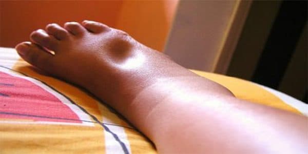 Phù chân là biến chứng xơ gan phổ biến