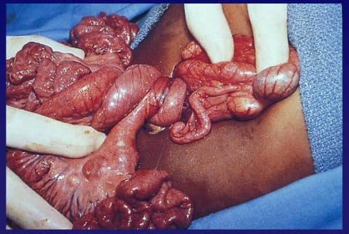 Xoắn ruột có nguy hiểm không là quan tâm của rất nhiều người.