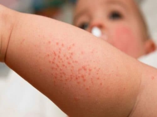 Không dùng kháng sinh với bệnh nhân sốt xuất huyết vì kháng sinh không có tác dụng tiêu diệt virus.