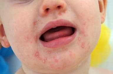 5 bệnh trẻ dễ mắc vào mùa hè Bệnh tay – chân – miệng