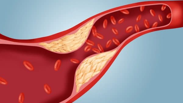 Cholesterol tăng cao không kiểm soát được có thể dẫn đến xơ vữa động mạch, xuất hiện khi các mảng bám tích tụ trong thành động mạch