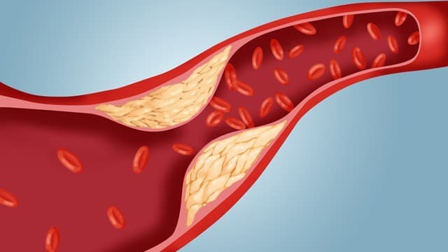 Cholesterol tăng cao có thể dẫn đến bệnh gì?