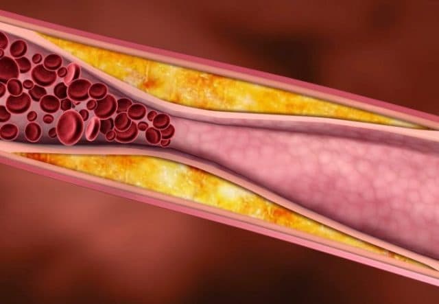 Bệnh máu nhiễm mỡ nguy hiểm như thế nào?